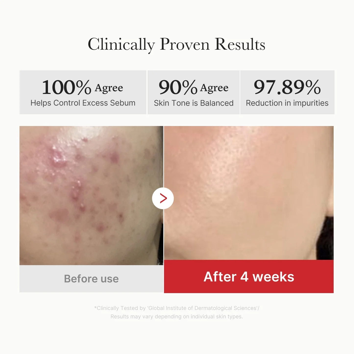 Medicube Red Acne Succinic Acid Peel | Peeling Serum 40g